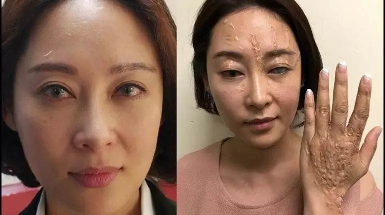 【突發】 楊卓娜 (霞姐) 被 隱形眼鏡刮致眼盲毀容，TVB與楊卓娜即時終止合約！